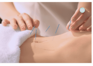 Aiguilles d’acupuncture posées sur le bas-ventre d’un patient lors d’une séance d'acupuncture